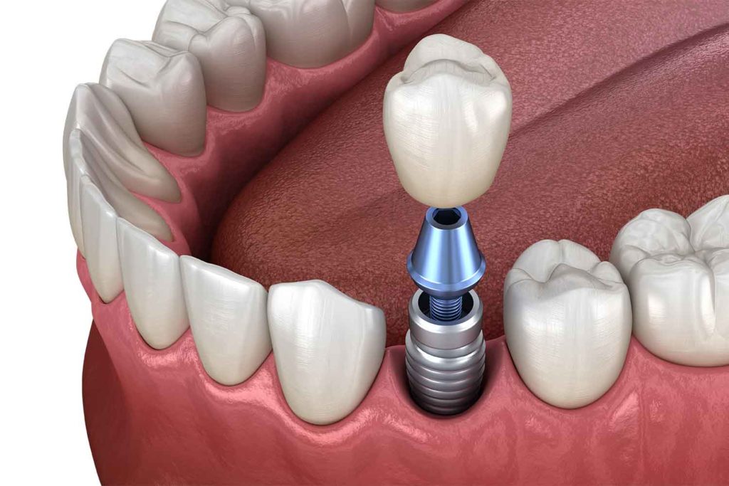 dental crown placed on implant abutment
